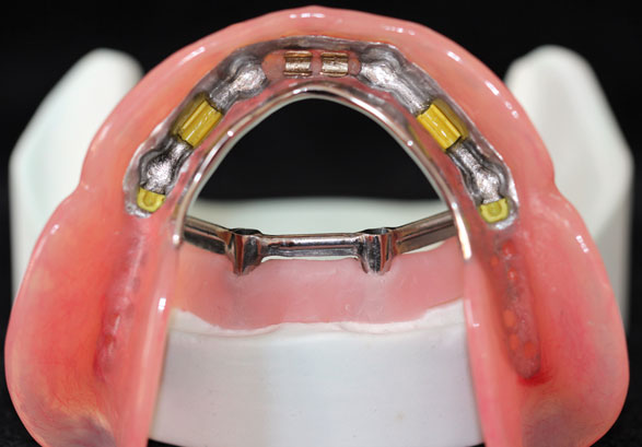 Acrylic Denture Over Implant Bar