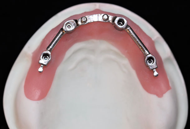 Implant Crown/Bridge